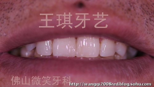 http://wq88.com/upload/2010/4/门牙间隙光固化树脂关闭2.jpg