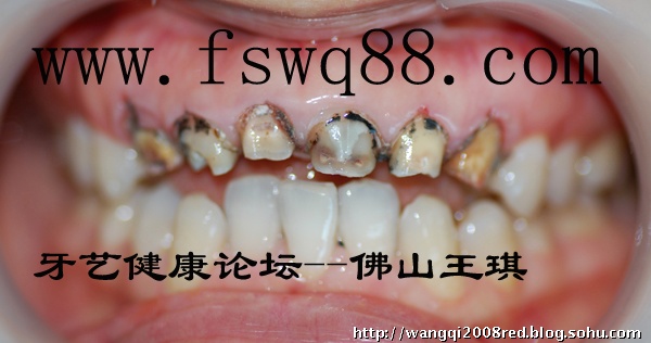 http://wq88.com/upload/2011/2/烤瓷牙边缘严重不密合的危害.jpg